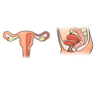 Endometrite ed infertilità